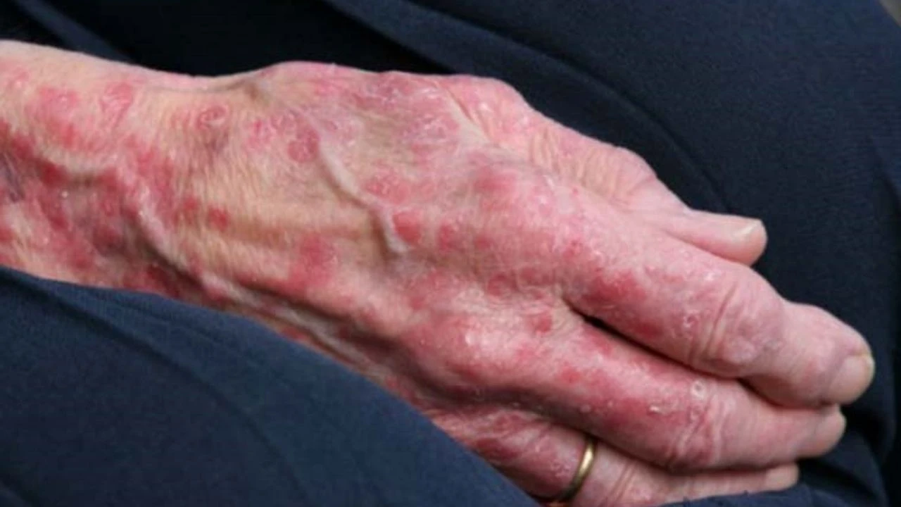 Romanya’da 40 yıl sonra cüzzam hastalığı tespit edildi